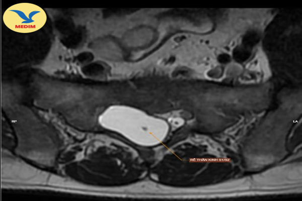 Quy trình chụp MRI đánh giá dòng chảy qua nang Tarlov